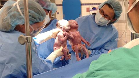 Διδυμάκια βγήκαν από την κοιλιά της μαμάς τους πιασμένα χέρι - χέρι! 