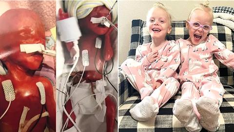 Τα πιο πρόωρα δίδυμα του κόσμου είναι πλέον 3 χρονών και μας γεμίζουν ελπίδα!