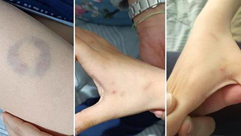 Διευθύντρια ειδικού σχολείου δάγκωσε 11χρονο μαθητή με αυτισμό