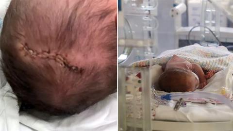 Μωράκι έπεσε στο πάτωμα την ώρα της γέννας και χρειάστηκε 11 ράμματα!