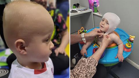 Μωράκι με πλαγιοκεφαλία θα λάβει επιτέλους τη θεραπεία που θα του αλλάξει τη ζωή!