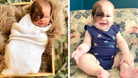 «Η κόρη μου γεννήθηκε με σπάνιο εκ γενετής σημάδι κι είναι πανέμορφη»