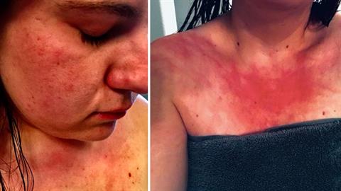 18χρονη εμφάνισε ξαφνικά αλλεργία στο νερό - συμβαίνει 1 στα 200 εκατομμύρια