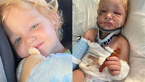 2χρονη δέχτηκε φονική επίθεση από τα κουτάβια της - της έφαγαν το αφτί