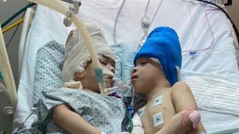 Γιατρός κατάφερε να χωρίσει σιαμαία διδυμάκια που ήταν ενωμένα στο κεφάλι