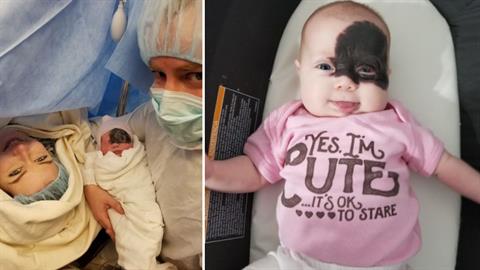 «Η κόρη μας γεννήθηκε με σπάνιο εκ γενετής σημάδι και μοιάζει με υπερήρωα!»