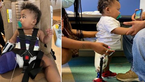 Μωράκι με σπάνια πάθηση κατάφερε να περπατήσει με τη βοήθεια πρόσθετου μέλους