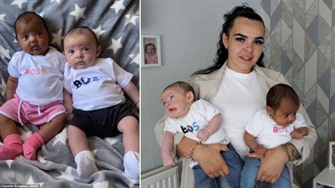 Διδυμάκια γεννήθηκαν με διαφορετικό χρώμα δέρματος - συμβαίνει 1 στο εκατομμύριο