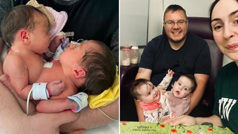 Σιαμαία που γεννήθηκαν με ενωμένη κοιλιά, διαχωρίστηκαν μετά από επέμβαση 24 ωρών!