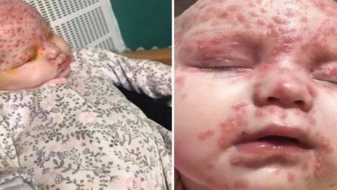 «Το αθώο φιλί ενός συγγενή παραλίγο να αφήσει την κόρη μας τυφλή»