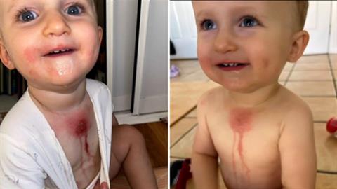 Νηπιάκι έπαθε φρικτά εγκαύματα από τον... χυμό ενός λεμονιού! 