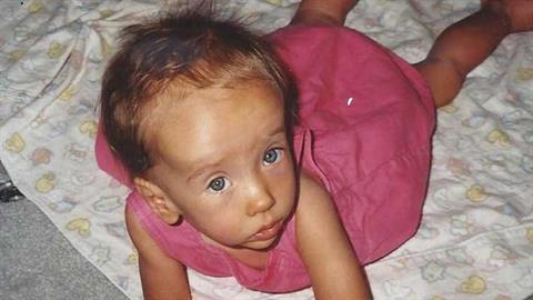 Τι είναι το σύνδρομο Sotos που εμφανίζεται σε 1 στα 10.000 παιδιά;