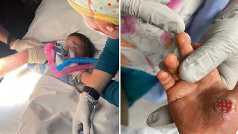 Νηπιάκι έπαθε σοβαρό έγκαυμα στο χέρι - ακούμπησε το μάτι της κουζίνας