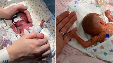 Πρόωρο κοριτσάκι που γεννήθηκε στις 23 εβδομάδες κέρδισε τη μάχη της ζωής του!