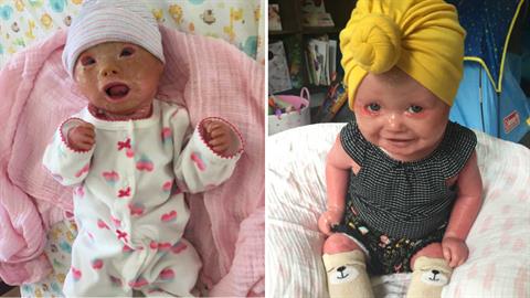 «Η κόρη μου γεννήθηκε με σπάνια δερματική πάθηση και έχει την πιο όμορφη ψυχή»