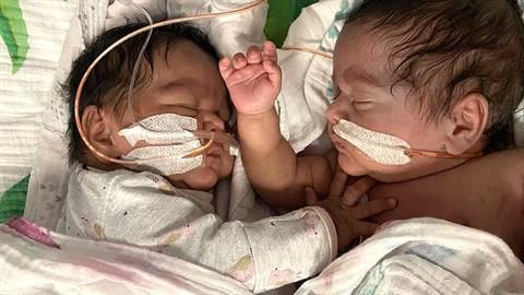 Πρόωρα διδυμάκια έπαθαν μηνιγγίτιδα και σήψη, αλλά νίκησαν τον θάνατο μαζί!