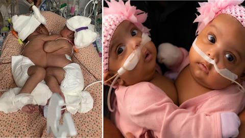 Ιατρικό θαύμα: σιαμαία που γεννήθηκαν ενωμένα στην κοιλιά, διαχωρίστηκαν μετά από επέμβαση 11 ωρών!