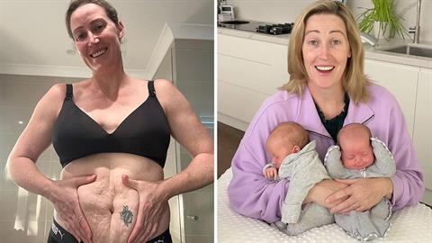 «Έτσι είναι ένα αληθνό σώμα μετά τον τοκετό: σημαδεμένο και όμορφο»