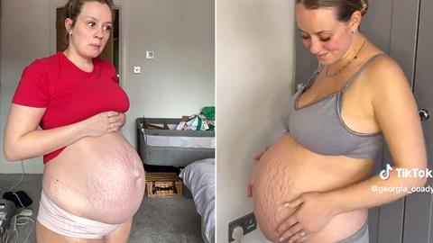 «Η κοιλιά μου μοιάζει με ετοιμόγεννης αλλά είμαι μόνο 22 εβδομάδων έγκυος»