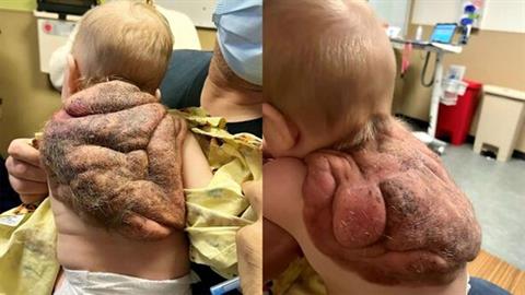 Η απίστευτη ιστορία του «παιδιού-χελώνα» με το τεράστιο καβούκι στην πλάτη του