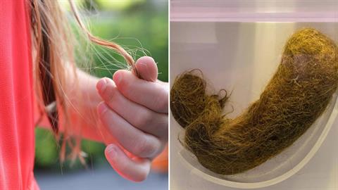 Σύνδρομο Rapunzel: αφαίρεσαν 700 γραμμάρια τρίχες από το στομάχι 14χρονης στη Θεσσαλονίκη