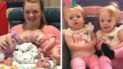 «Έγινε θαύμα»: διδυμάκια ενωμένα στo κεφάλι διαχωρίστηκαν με επιτυχία!