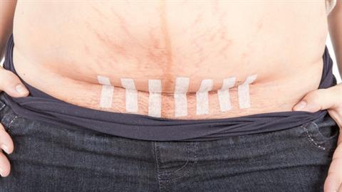 «Η καισαρική δεν είναι η εύκολη λύση. Είναι μια επώδυνη επέμβαση»