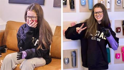 15χρονη χωρίς χέρι απέκτησε βιονικό βραχίονα και δεν μπορεί να κρύψει τη χαρά της!