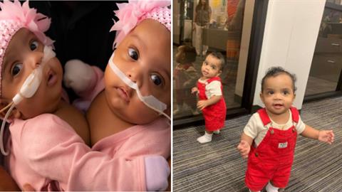 Σιαμαία που χωρίστηκαν ξεπέρασαν τον κίνδυνο και έσβησαν το 1ο τους κεράκι!