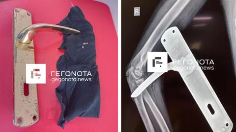 Δημοτικό σχολείο στον Βόλο: πόμολο καρφώθηκε στο χέρι ενός μαθητή 