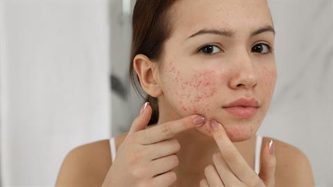 Βρέθηκαν καρκινογόνες ουσίες σε προϊόντα Clearasil και Clinique για την ακμή 