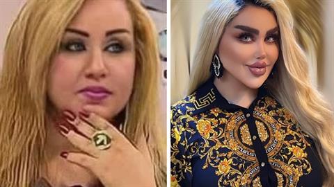 30χρονη έκανε 43 πλαστικές επεμβάσεις για να μοιάσει στην... Barbie!