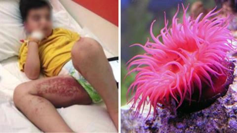 Ναύπλιο: θαλάσσιες ανεμώνες «επιτέθηκαν» σε παιδάκι και το έστειλαν στο νοσοκομείο! 
