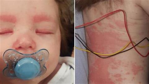 Κεραυνοβόλος μηνιγγίτιδα: μπορεί να οδηγήσει σε ξαφνικό θάνατο; Τι να προσέξουμε