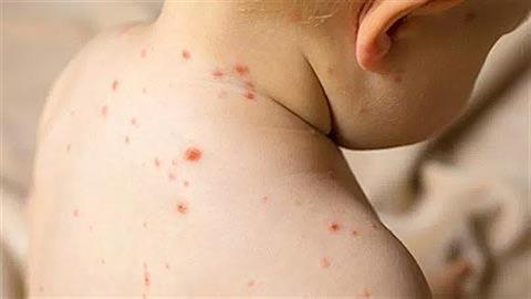 ΗΠΑ: 1ος θάνατος παιδιού από ιλαρά εδώ και 10 χρόνια - ήταν ανεμβολίαστο