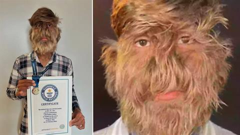 Ο 18χρονος με το «σύνδρομο του λυκανθρώπου» γράφει ιστορία ως «το πιο τριχωτό πρόσωπο»