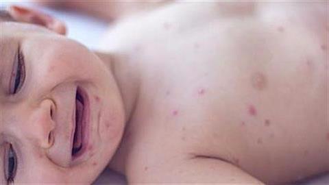 Ιλαρά: διπλασιάστηκαν τα κρούσματα - όλο και λιγότερα τα εμβολιασμένα παιδιά