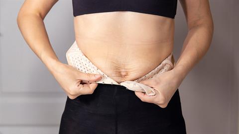 Τι είναι η διάσταση λευκής γραμμής που παρατηρείται μετά την εγκυμοσύνη