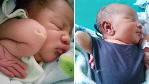 Μωράκι γεννιέται με τους αγκώνες προς τα πάνω, λόγω σπάνιας ασθένειας