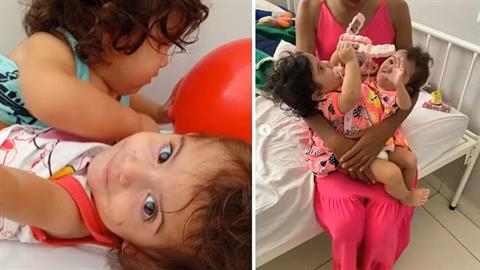 Σιαμαία ενωμένα σε κοιλιά, στήθος και λεκάνη, διαχωρίστηκαν μετά από 15 ώρες χειρουργείο!