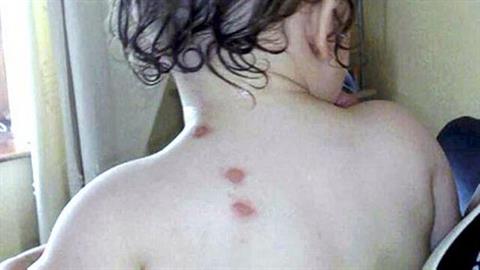 Σοκ στη Λάρισα: μαμά έκαιγε με τσιγάρο τα 2 παιδιά της για να τα τιμωρεί