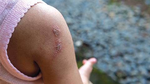 Στρεπτοκοκκική λοίμωξη: μπορεί να οδηγήσει σε ξαφνικό θάνατο - οδηγίες προστασίας από τον ΕΟΔΥ