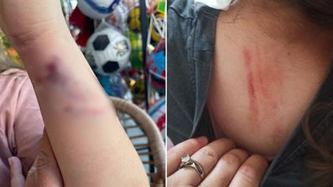 Πέλλα: 10χρονη δέχτηκε άγρια επίθεση από σκύλο - την έσωσε περαστικός τελευταία στιγμή!