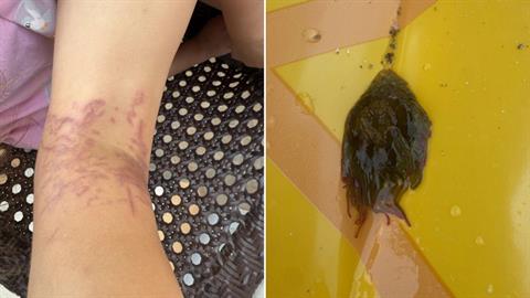 Κέα: δηλητηριώδης θαλάσσια ανεμώνη τσίμπησε 6χρονη - γύρισε στην Αθήνα για νοσηλεία