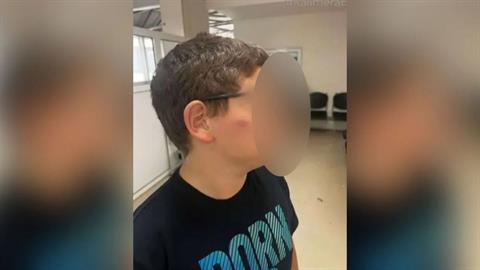 11χρονος ξυλοκοπήθηκε από συμμαθητές του στο σχολείο - του κάνουν 3 χρόνια bullying