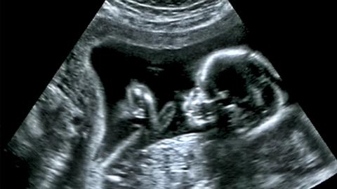 Νέο γενετικό τεστ στην εξωσωματική: €50.000 για το «τέλειο» μωρό