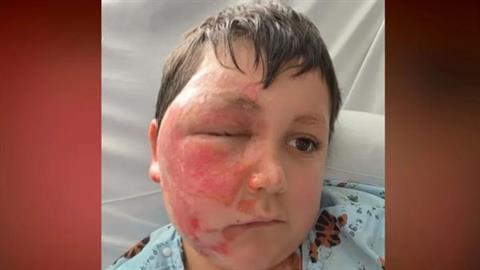 Επικίνδυνο challenge του TikTok έστειλε 9χρονο στο νοσοκομείο με εγκαύματα στο πρόσωπο!