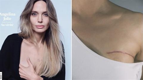 Α.Τζολί για μαστεκτομή: «δεν με ελκύει η ιδέα μιας τέλειας ζωής χωρίς πληγές»
