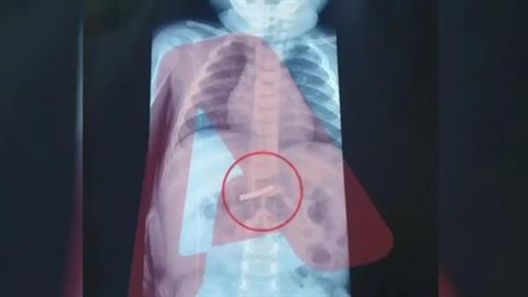 Αγωνιά για 3χρονο που κατάπιε ξυραφάκι - νοσηλεύεται στο Παίδων