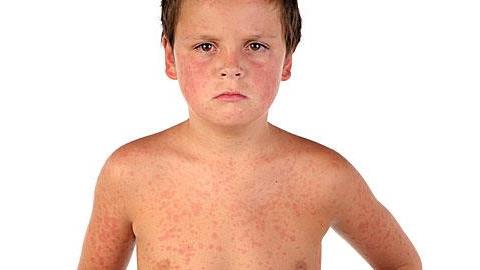 Ιλαρά: Όσα πρέπει να γνωρίζετε